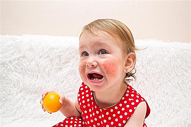 Citrus allergy symptoms